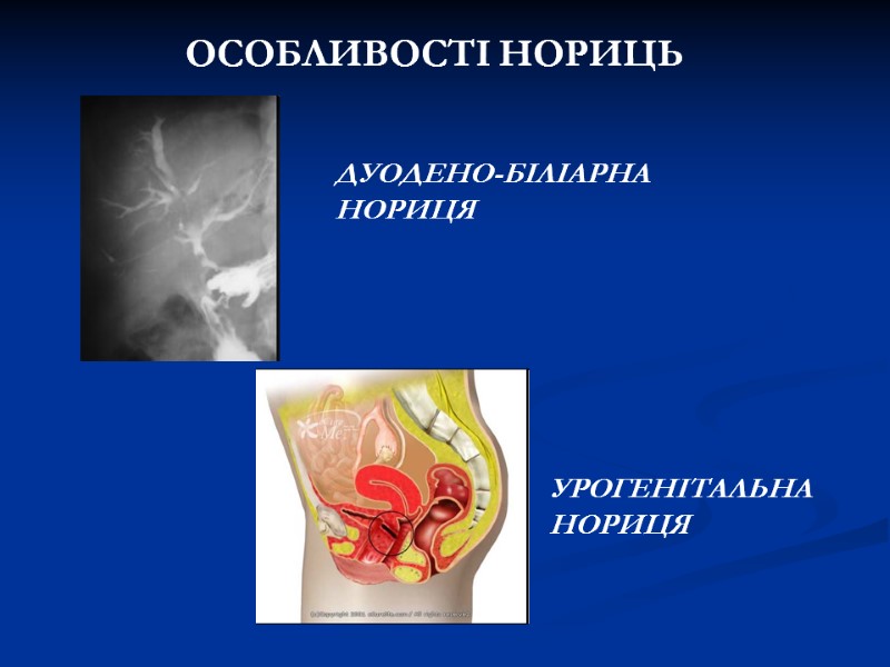 ОСОБЛИВОСТІ НОРИЦЬ ДУОДЕНО-БІЛІАРНА НОРИЦЯ УРОГЕНІТАЛЬНА НОРИЦЯ ОСОБЛИВОСТІ НОРИЦЬ ДУОДЕНО-БІЛІАРНА НОРИЦЯ УРОГЕНІТАЛЬНА НОРИЦЯ
